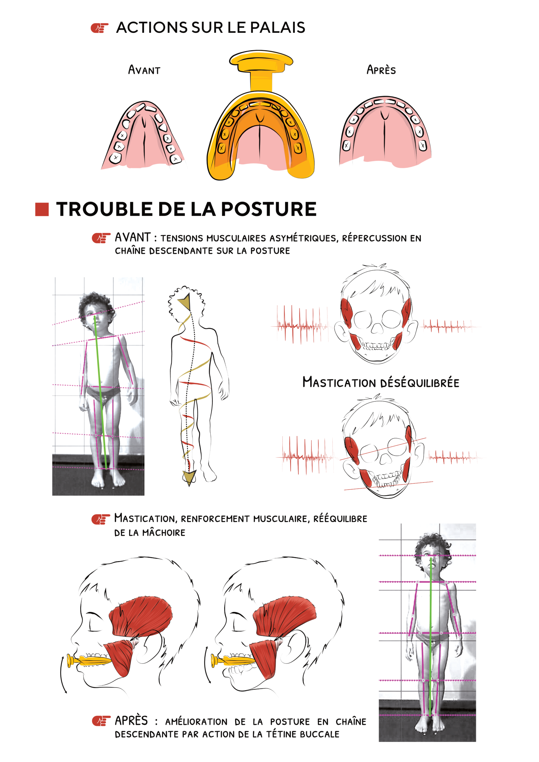 Prévenir les compensations orales chez l’enfant lors du stop tétine