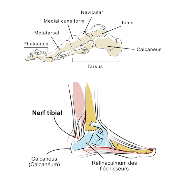 Douleur au talon liée à une épine calcanéenne au niveau du calcanéum