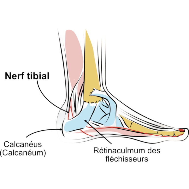Relation entre épine calcanéenne et fasciite plantaire au niveau du pied