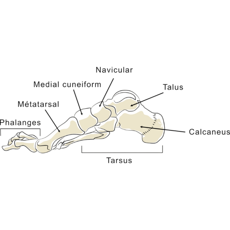 Schéma illustrant la localisation d’une épine calcanéenne sous le talon