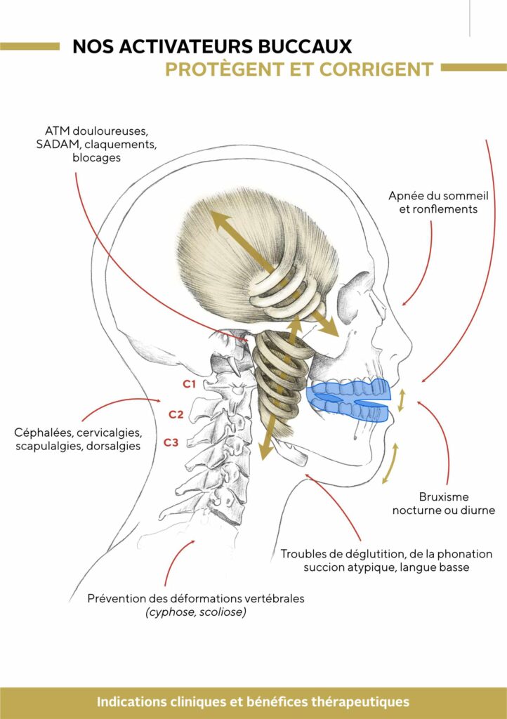 Gouttière anti-ronflement portée en bouche pendant le sommeil